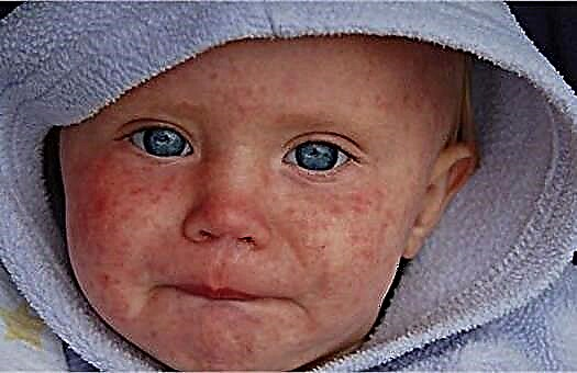 Como é o sarampo em crianças: sintomas na fase inicial