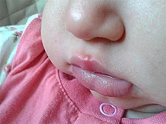 Herpes på et barns læbe