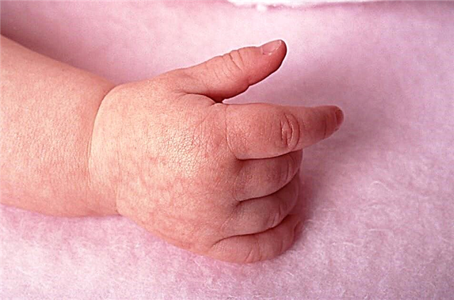 Kulit marmer pada bayi dan bayi baru lahir: penyebab, gejala penyakit dan pengobatan