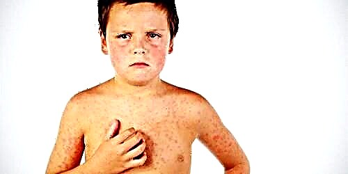 Signs and treatment of pink lichen in a child