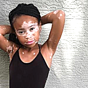Vitiligo u detí