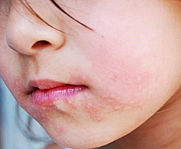 What to do if irritation or rash develops around your child's mouth?