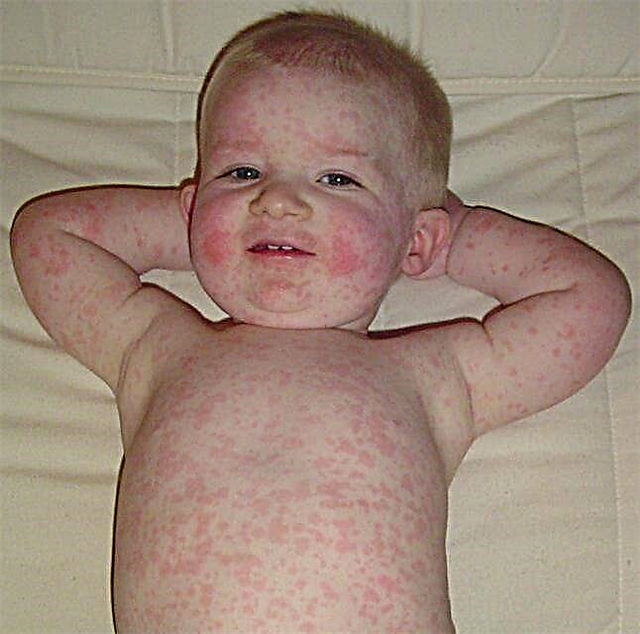 ماذا تفعل إذا كان الطفل يعاني من طفح جلدي في جميع أنحاء الجسم ولكن لا توجد درجة حرارة؟