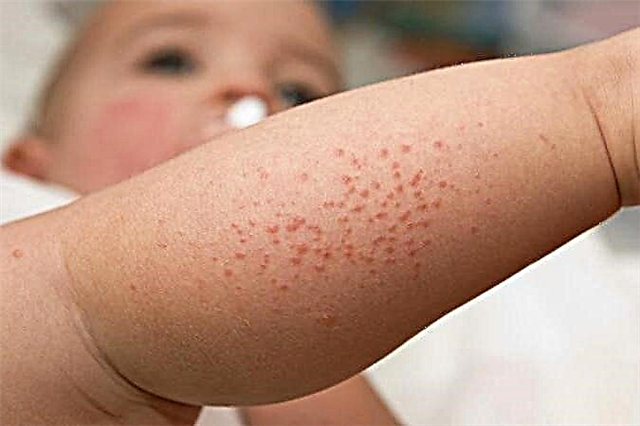 Rash on the legs of a child