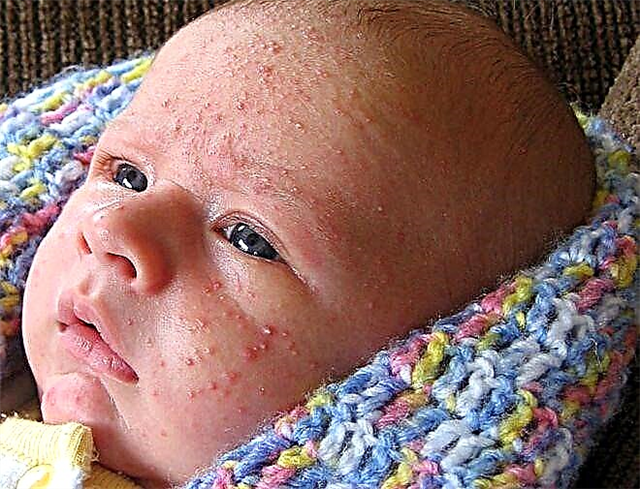 Hormonal rash in newborns and infants