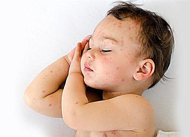Rash on the body and itching in a child