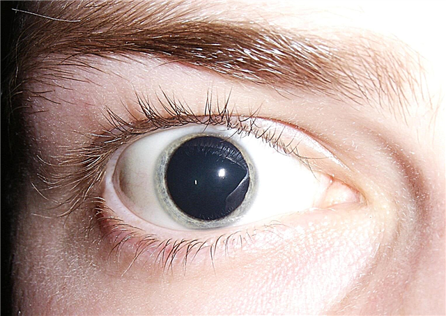 Causes of dilated pupils in a child