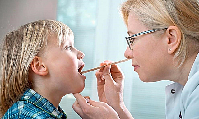 Viêm họng do virus ở trẻ em