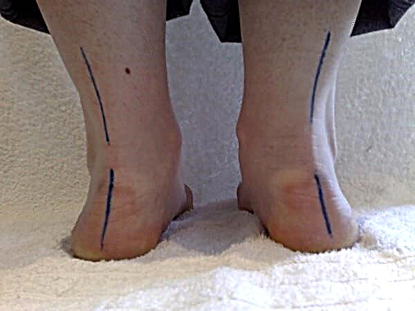 어린이의 편평한 외반 발 치료