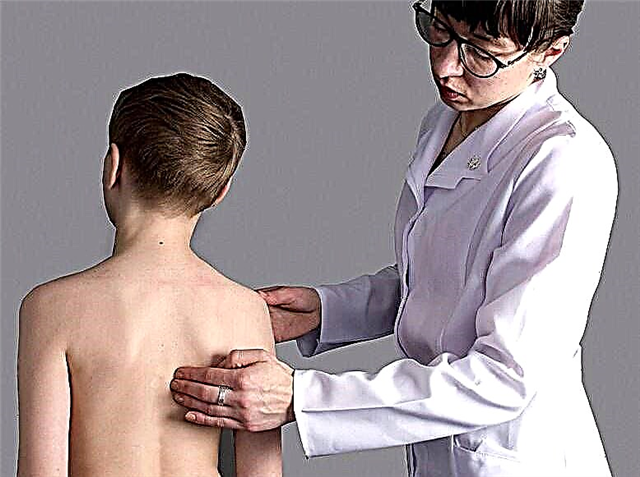 Kompresjonsbrudd i ryggraden hos barn: symptomer, behandling og rehabilitering