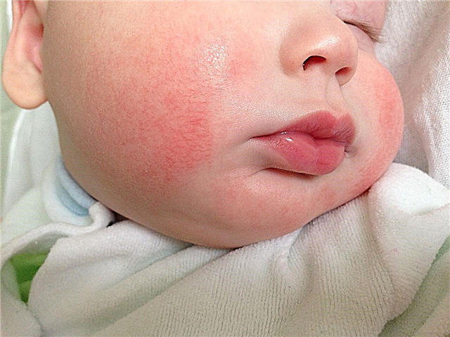 À quoi ressemble l'allergie cutanée d'un enfant?