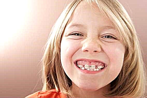 Piastre di allineamento dei denti per bambini