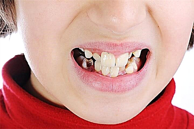 A fogak fekete lepedékének okai gyermekeknél