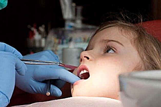 Trattamento della pulpite dei denti da latte nei bambini