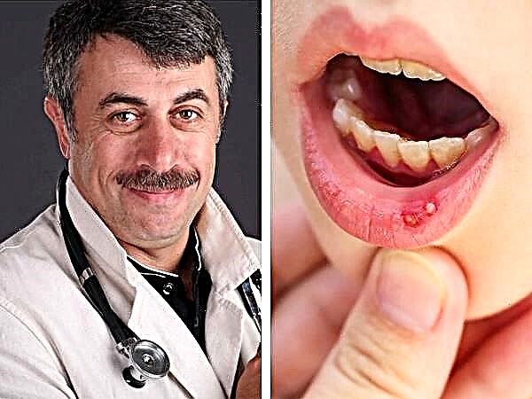 Bác sĩ Komarovsky về bệnh viêm miệng