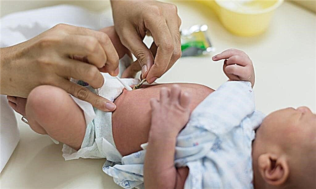 استخدام الكلوروفيلبت لعلاج سرة الأطفال حديثي الولادة 