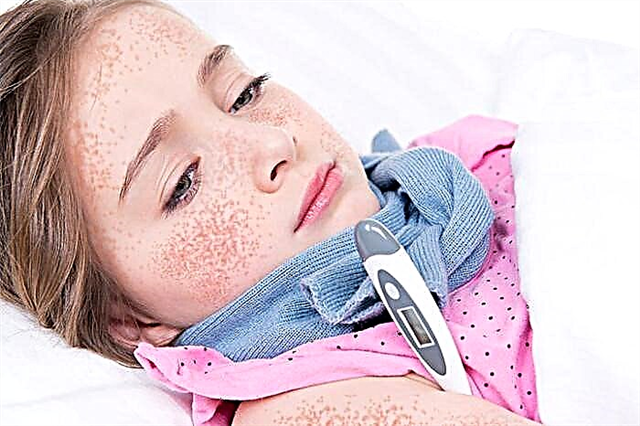 Bệnh ban đỏ ở trẻ em: triệu chứng và cách điều trị (17 ảnh)