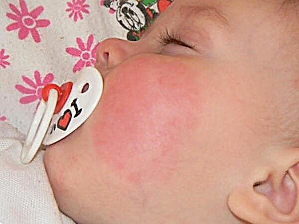 Tratamiento de la diátesis en las mejillas en un niño.