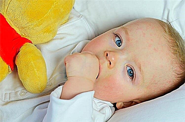 Tratamento da dermatite atópica em crianças com remédios populares