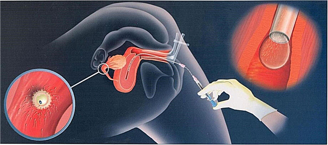 Hva er intrauterin inseminasjon og hvordan utføres prosedyren?