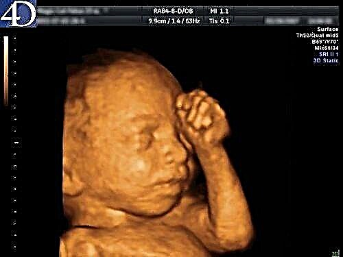 4D ultrasound during pregnancy