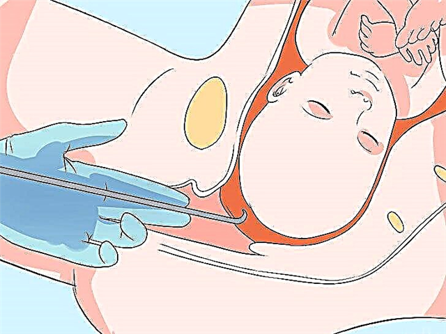 Punção da bexiga para indução do parto
