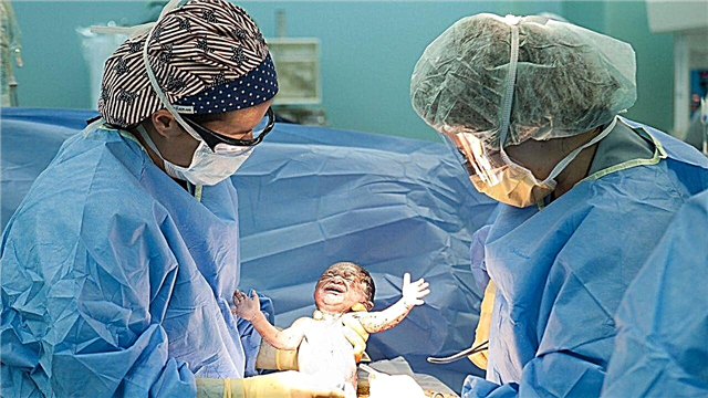 Features of an emergency caesarean section