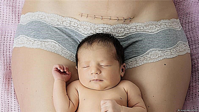 Wie ist ein Kaiserschnitt: Phasen der Operation