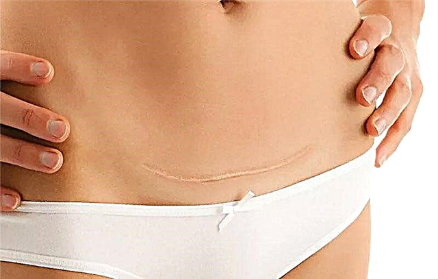¿Cuántos días suele curar una sutura después de una cesárea?