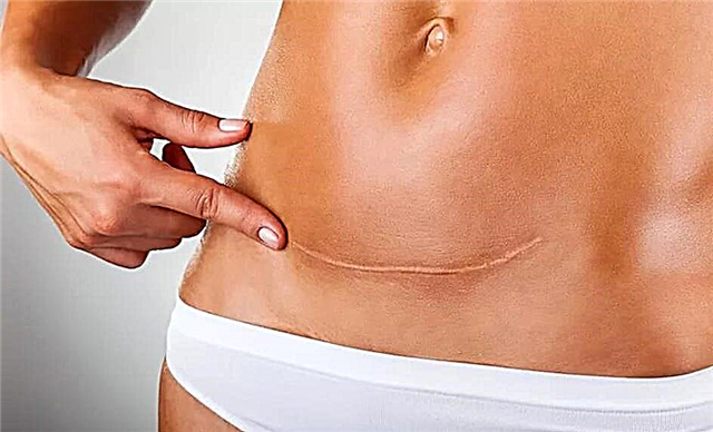 Que faire si la suture s'est détachée après une césarienne?