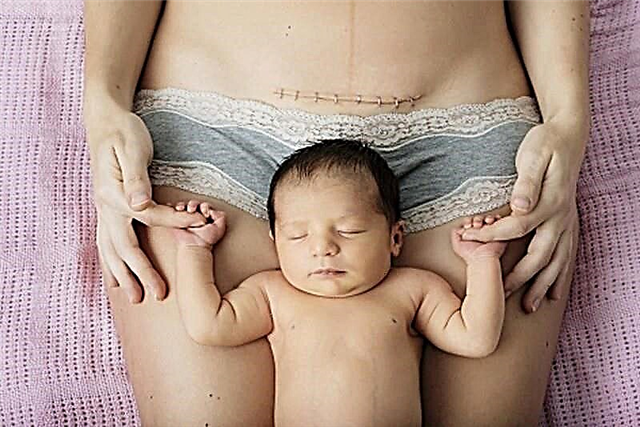 الخياطة بعد الولادة القيصرية: المشاكل المحتملة والعلاج