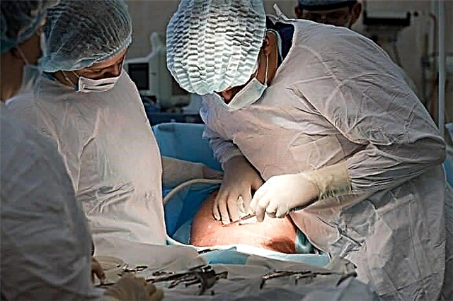האם ניתן לבצע ניתוח קיסרי רביעי? ביקורות ודעות של רופאים