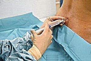Anestesia spinale per taglio cesareo