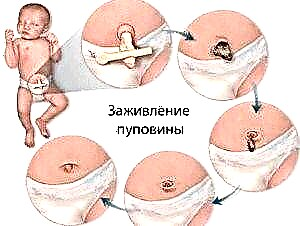 Kako liječiti pupkovinu u novorođene bebe