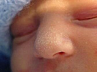 Odkud pocházejí pupínky na tváři novorozence a co s nimi