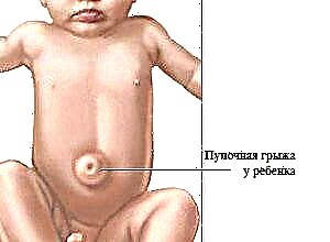 Symptoms of an umbilical hernia in babies and how to treat it