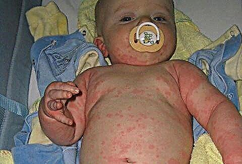 Cum se tratează varicela la sugari: simptome ale varicelei