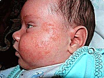 Sintomi, cause e trattamento della diatesi nei neonati (rimedi popolari per la diatesi)