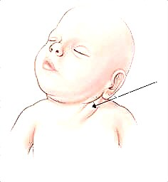 Tortikolis pada bayi: sebab dan kaedah rawatan (urut / gimnastik)