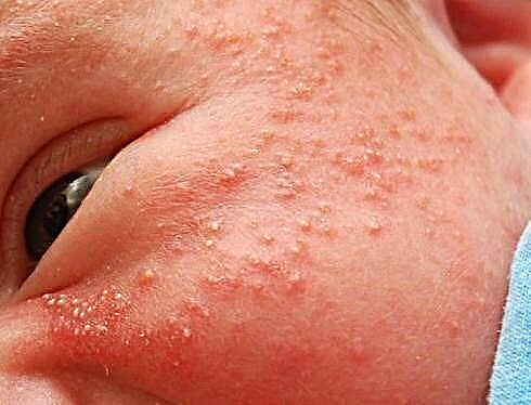 Akné u novorozenců (pupínků). Jak se nezaměňovat s alergiemi