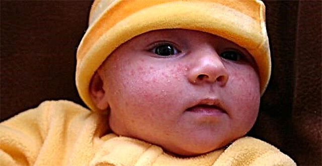 Myter och sanningar om nyfödd akne