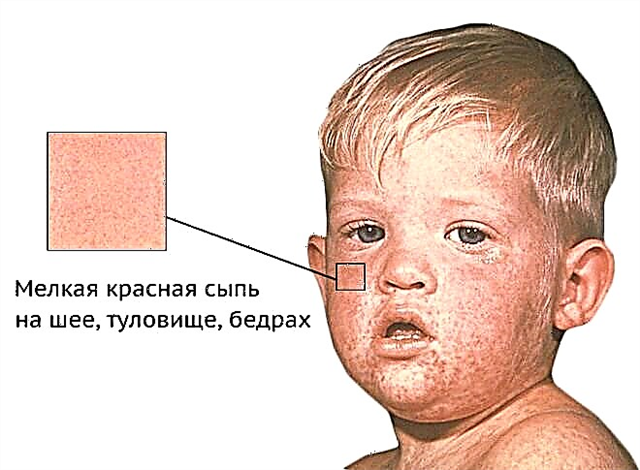 Vaktsineerimine leetrite, punetiste, mumpsi vastu