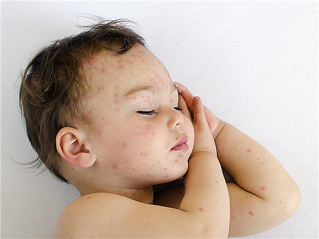 Infant rashes! Causes and solutions to the problem